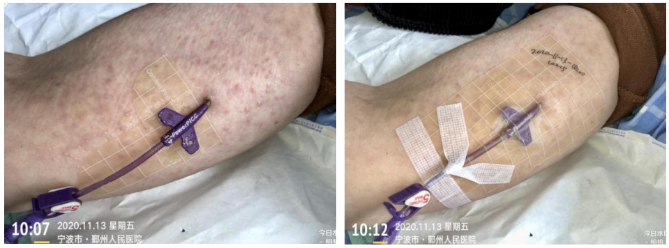 什么是医用导管固定贴PICC 局部发红发痒：是贴膜过敏，还是接触性皮炎？一文理清！_https://www.jmylbn.com_新闻资讯_第8张