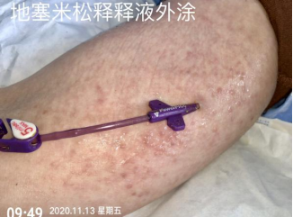 什么是医用导管固定贴PICC 局部发红发痒：是贴膜过敏，还是接触性皮炎？一文理清！_https://www.jmylbn.com_新闻资讯_第7张