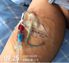 什么是医用导管固定贴PICC 局部发红发痒：是贴膜过敏，还是接触性皮炎？一文理清！_https://www.jmylbn.com_新闻资讯_第10张