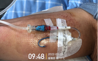 什么是医用导管固定贴PICC 局部发红发痒：是贴膜过敏，还是接触性皮炎？一文理清！_https://www.jmylbn.com_新闻资讯_第12张