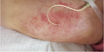 什么是医用导管固定贴PICC 局部发红发痒：是贴膜过敏，还是接触性皮炎？一文理清！_https://www.jmylbn.com_新闻资讯_第4张