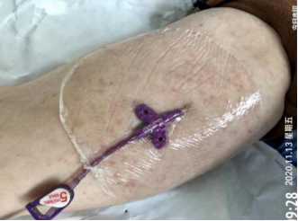 什么是医用导管固定贴PICC 局部发红发痒：是贴膜过敏，还是接触性皮炎？一文理清！_https://www.jmylbn.com_新闻资讯_第5张