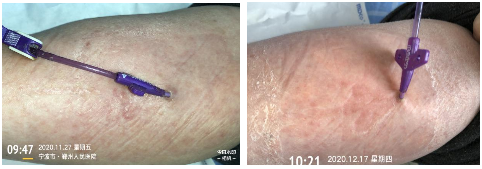 什么是医用导管固定贴PICC 局部发红发痒：是贴膜过敏，还是接触性皮炎？一文理清！_https://www.jmylbn.com_新闻资讯_第9张