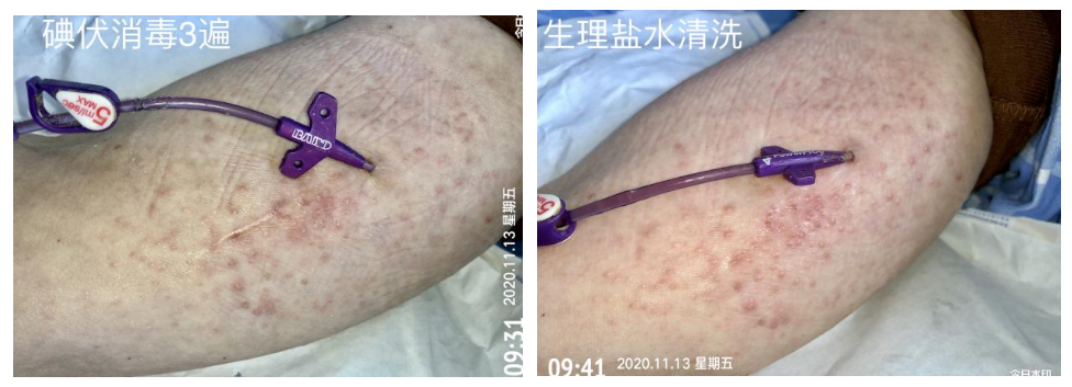 什么是医用导管固定贴PICC 局部发红发痒：是贴膜过敏，还是接触性皮炎？一文理清！_https://www.jmylbn.com_新闻资讯_第6张