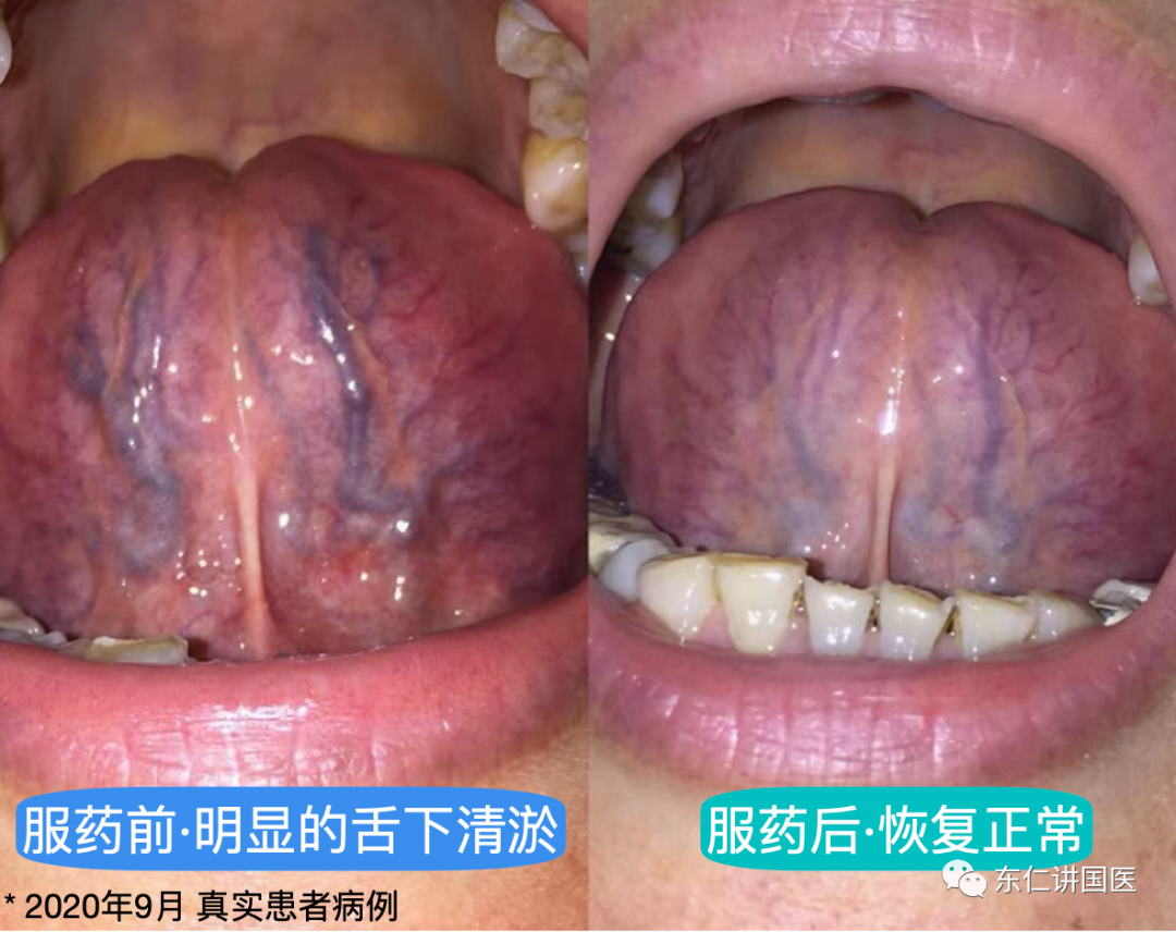 自查 口唇青紫 舌下青瘀 东仁讲国医 微信公众号文章阅读 Wemp