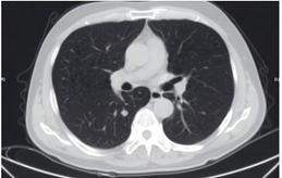 肺部小结节 肺部小结节