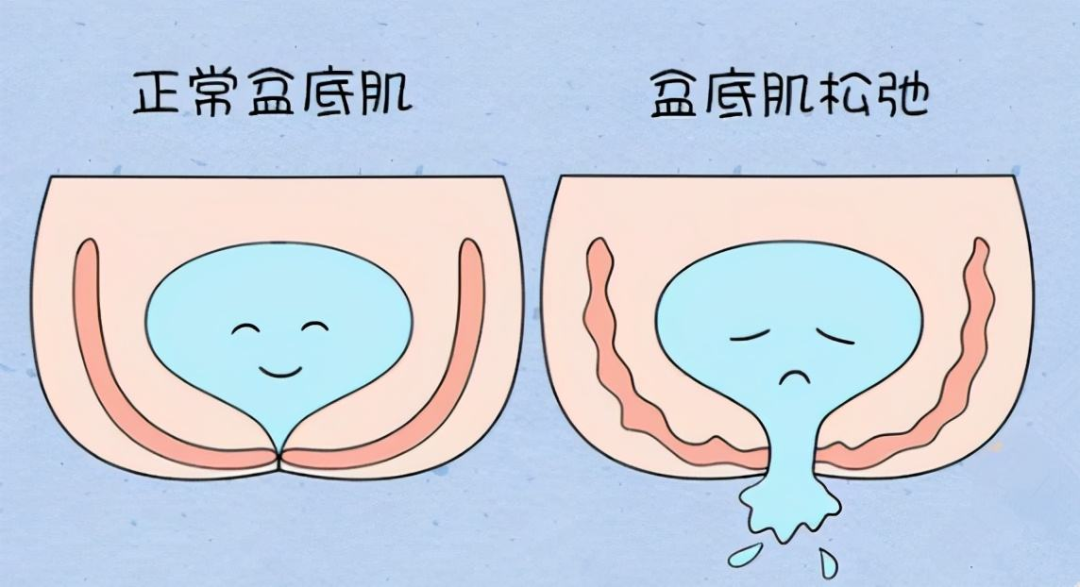 因为漏尿50岁的她要穿纸尿裤盆底康复治疗到底有多重要