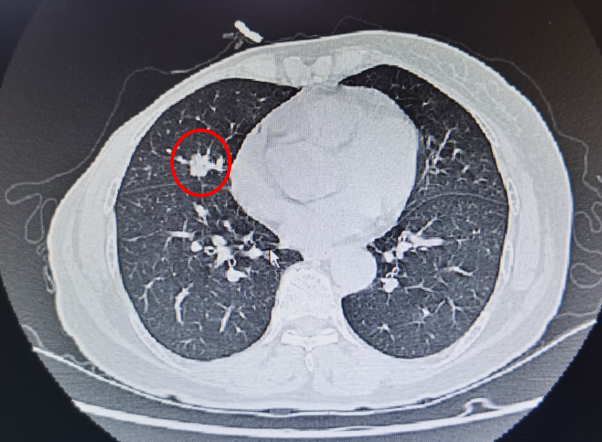 穿刺活检枪怎么用一个真实病例，带您认识肿瘤内科的“神枪手”与经皮肺穿刺活检术_https://www.jmylbn.com_新闻资讯_第5张