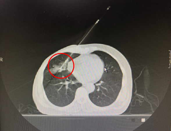 穿刺活检枪怎么用一个真实病例，带您认识肿瘤内科的“神枪手”与经皮肺穿刺活检术_https://www.jmylbn.com_新闻资讯_第6张