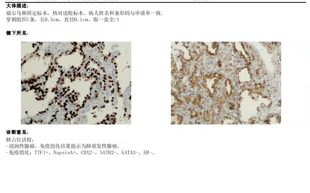 穿刺活检枪怎么用一个真实病例，带您认识肿瘤内科的“神枪手”与经皮肺穿刺活检术_https://www.jmylbn.com_新闻资讯_第7张