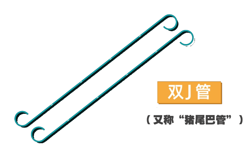 猪输尿管怎么吃【典型案例】怀孕7月腹痛不止，医生巧用“猪尾巴管”安全解决！_https://www.jmylbn.com_新闻资讯_第4张