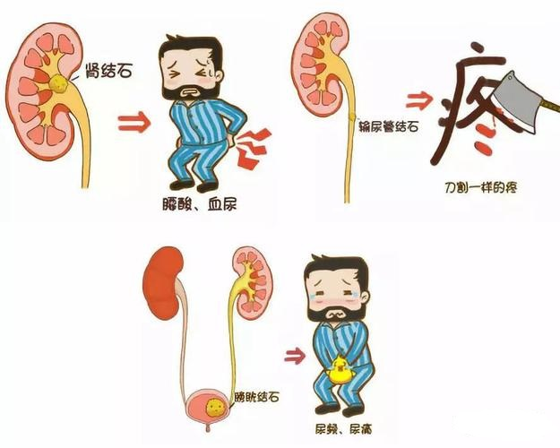 什么是输尿管镜健康科普丨输尿管软镜，让泌尿系结石“无处遁形”_https://www.jmylbn.com_新闻资讯_第6张