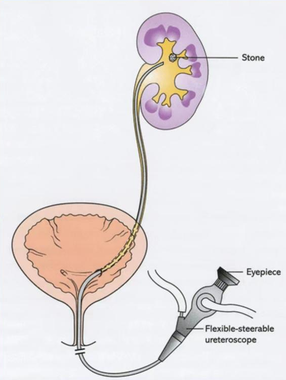 什么是输尿管镜健康科普丨输尿管软镜，让泌尿系结石“无处遁形”_https://www.jmylbn.com_新闻资讯_第7张