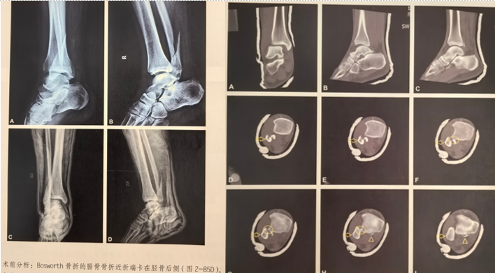Bosworth骨折手术治疗的细节是什么？（附积水潭病例）