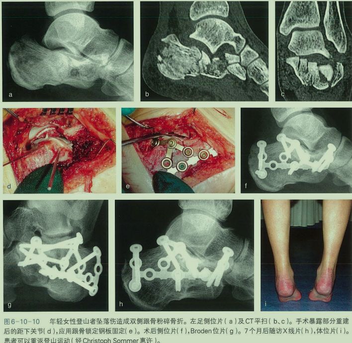 跟骨骨折如何轻松纠正内翻畸形，结合AO、坎贝尔、Rockwood、积水潭足踝外科经验总结及个人见解