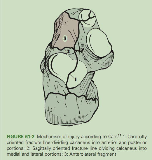 跟骨骨折如何轻松纠正内翻畸形，结合AO、坎贝尔、Rockwood、积水潭足踝外科经验总结及个人见解
