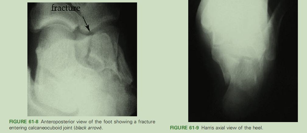 跟骨骨折如何轻松纠正内翻畸形，结合AO、坎贝尔、Rockwood、积水潭足踝外科经验总结及个人见解