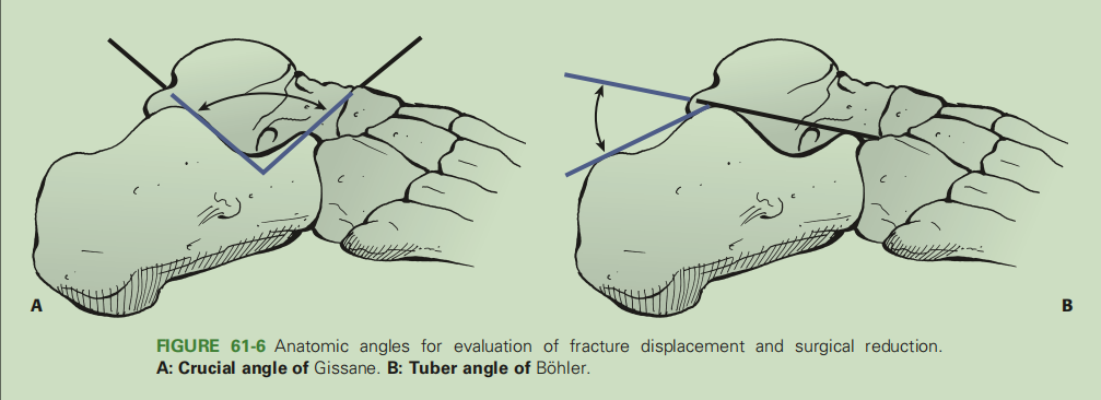 跟骨骨折如何轻松纠正内翻畸形，结合AO、坎贝尔、Rockwood、积水潭足踝外科经验总结及个人见解