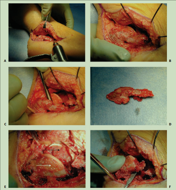 跟骨骨折如何轻松纠正内翻畸形，结合AO、坎贝尔、Rockwood、积水潭足踝外科经验总结及个人见解