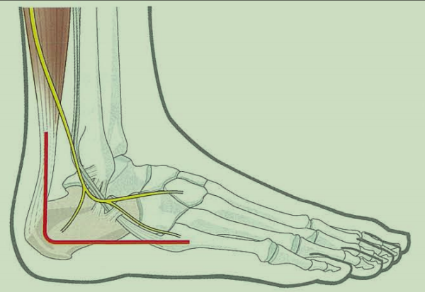 跟骨骨折如何轻松纠正内翻畸形，结合AO、坎贝尔、Rockwood、积水潭足踝外科经验总结及个人见解