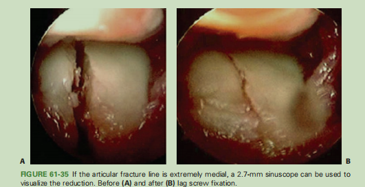 跟骨骨折如何轻松纠正内翻畸形，结合AO、坎贝尔、Rockwood、积水潭足踝外科经验总结及个人见解