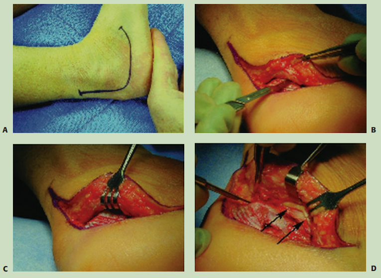 跟骨骨折如何轻松纠正内翻畸形，结合AO、坎贝尔、Rockwood、积水潭足踝外科经验总结及个人见解