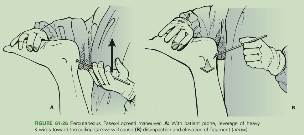 跟骨骨折如何轻松纠正内翻畸形，结合AO、坎贝尔、Rockwood、积水潭足踝外科经验总结及个人见解