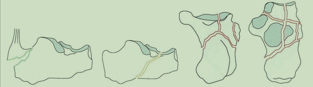 跟骨骨折如何轻松纠正内翻畸形，结合AO、坎贝尔、Rockwood、积水潭足踝外科经验总结及个人见解