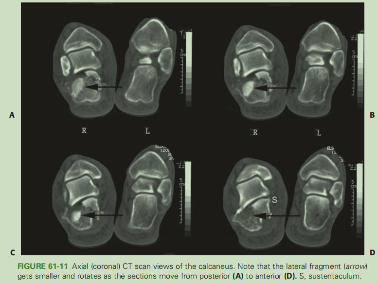 跟骨骨折如何轻松纠正内翻畸形，结合AO、坎贝尔、Rockwood、积水潭足踝外科经验总结及个人见解
