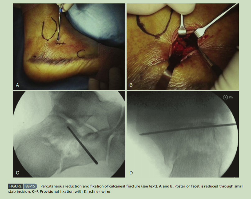 跟骨骨折如何轻松纠正内翻畸形，结合AO、坎贝尔、Rockwood、积水潭足踝外科经验总结及个人见解