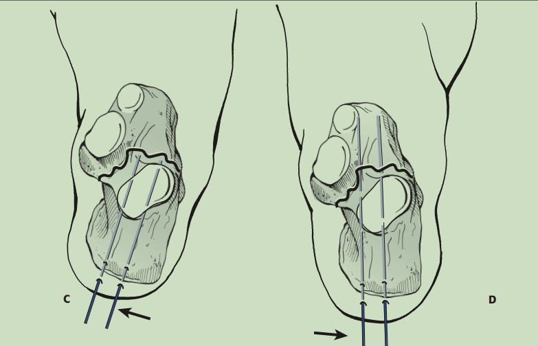 跟骨骨折如何轻松纠正内翻畸形，结合AO、坎贝尔、Rockwood、积水潭足踝外科经验总结及个人见解