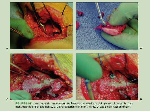 跟骨骨折如何轻松纠正内翻畸形，结合AO、坎贝尔、Rockwood、积水潭足踝外科经验总结及个人见解