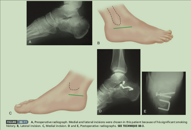 跟骨骨折如何轻松纠正内翻畸形，结合AO、坎贝尔、Rockwood、积水潭足踝外科经验总结及个人见解