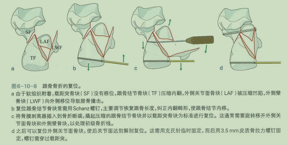 跟骨骨折如何轻松纠正内翻畸形，结合AO、坎贝尔、Rockwood、积水潭足踝外科经验总结及个人见解