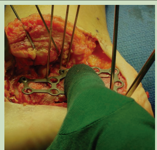 跟骨骨折如何轻松纠正内翻畸形，结合AO、坎贝尔、Rockwood、积水潭足踝外科经验总结及个人见解