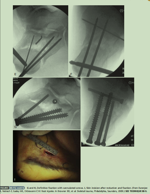 跟骨骨折如何轻松纠正内翻畸形，结合AO、坎贝尔、Rockwood、积水潭足踝外科经验总结及个人见解