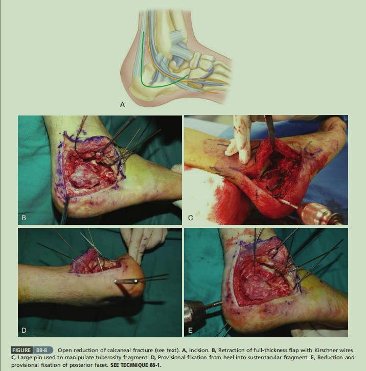 跟骨骨折如何轻松纠正内翻畸形，结合AO、坎贝尔、Rockwood、积水潭足踝外科经验总结及个人见解