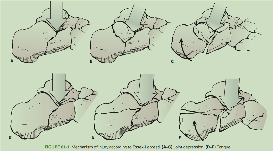 跟骨骨折如何轻松纠正内翻畸形，结合AO、坎贝尔、Rockwood、积水潭足踝外科经验总结及个人见解