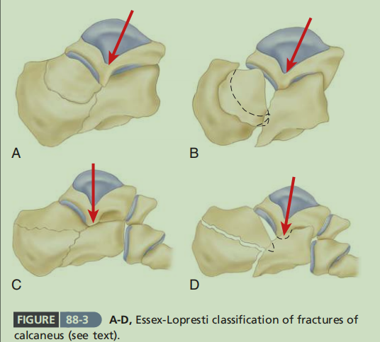 跟骨骨折如何轻松纠正内翻畸形，结合AO、坎贝尔、Rockwood、积水潭足踝外科经验总结及个人见解