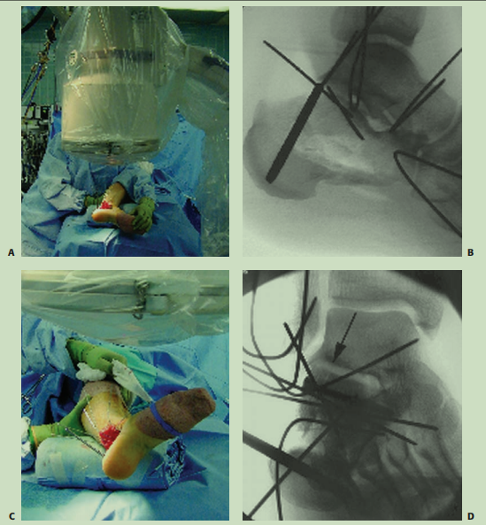 跟骨骨折如何轻松纠正内翻畸形，结合AO、坎贝尔、Rockwood、积水潭足踝外科经验总结及个人见解