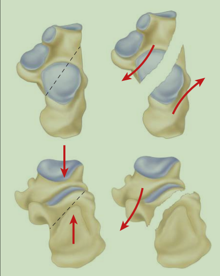 跟骨骨折如何轻松纠正内翻畸形，结合AO、坎贝尔、Rockwood、积水潭足踝外科经验总结及个人见解