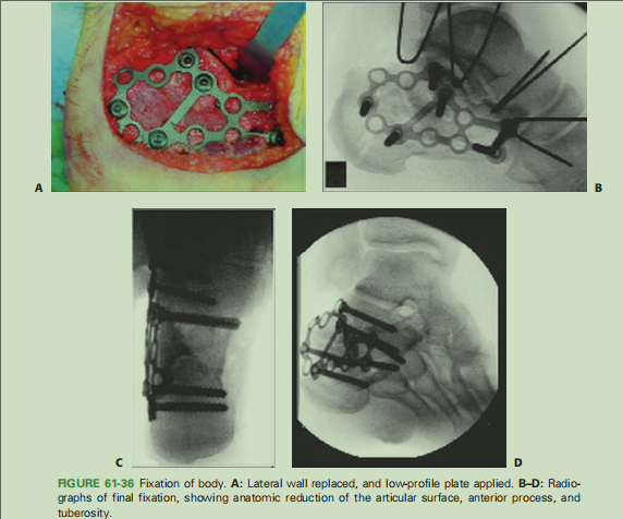 跟骨骨折如何轻松纠正内翻畸形，结合AO、坎贝尔、Rockwood、积水潭足踝外科经验总结及个人见解