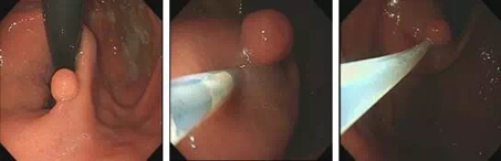 热活检钳有什么作用【健康科普】发现胃肠息肉，到底要不要切？_https://www.jmylbn.com_新闻资讯_第5张