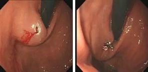 热活检钳有什么作用【健康科普】发现胃肠息肉，到底要不要切？_https://www.jmylbn.com_新闻资讯_第6张