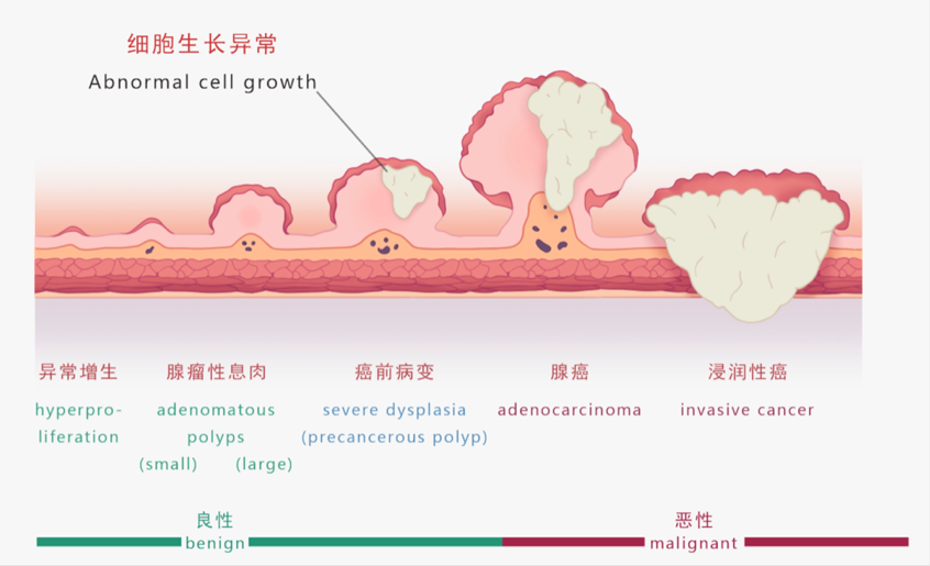 热活检钳有什么作用【健康科普】发现胃肠息肉，到底要不要切？_https://www.jmylbn.com_新闻资讯_第3张