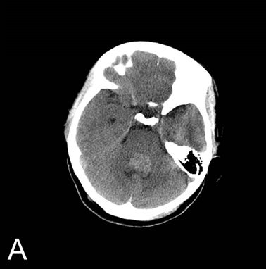 三甲读片 | 典型四脑室病变,过目不忘_医学界-助力医生临床决策和职业