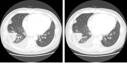 既往有冠心病5年,4年前心肌前壁梗死,前降支支架置入术后.