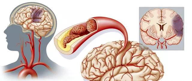 同型半氨酸怎么化验为什么要检测同型半胱氨酸_https://www.jmylbn.com_新闻资讯_第3张