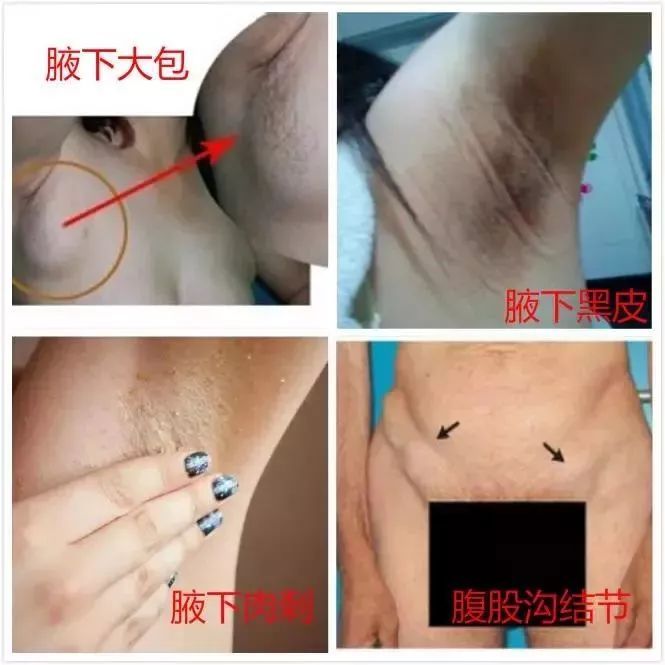 圣本堂本草液718期腋下淋巴堵塞原来这么可怕 不看还真不知道 广州圣本堂 微信公众号文章阅读 Wemp