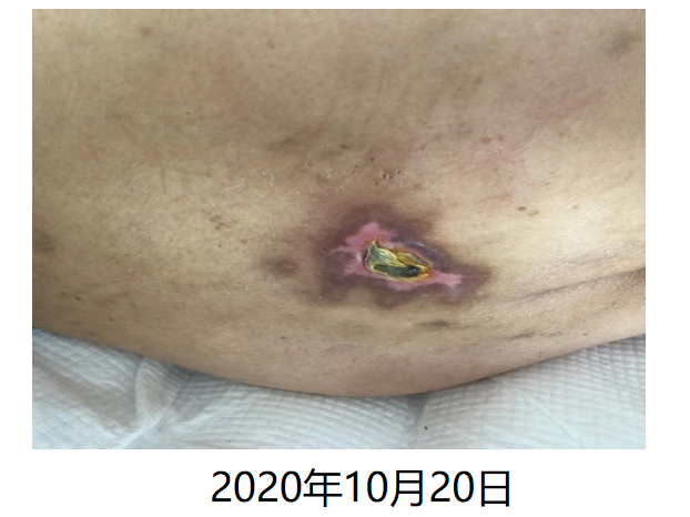 医用泡沫贴怎么用压疮护理不用愁！医用褥疮贴买一送一！_https://www.jmylbn.com_新闻资讯_第9张